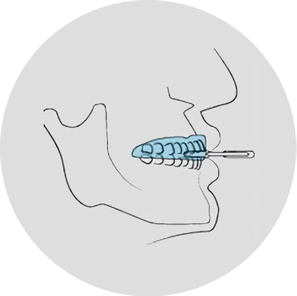 Mould to your teeth